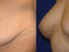 2b-breast-lift-and-implants-combined